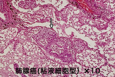 免液細胞型腺癌　顕微鏡写真